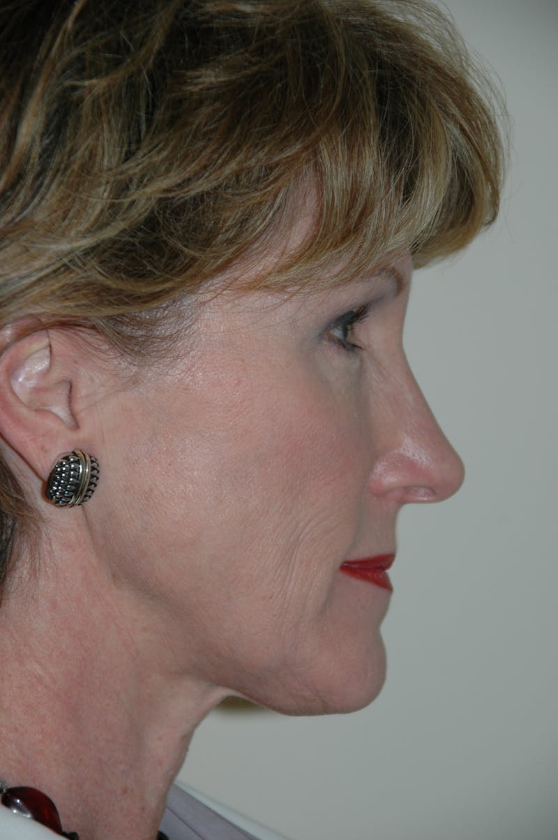Facelift Before & After Gallery - Patient 53599912 - Image 3