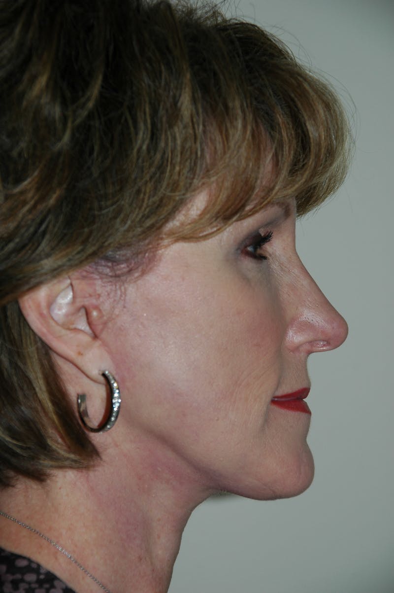 Facelift Before & After Gallery - Patient 53599912 - Image 4
