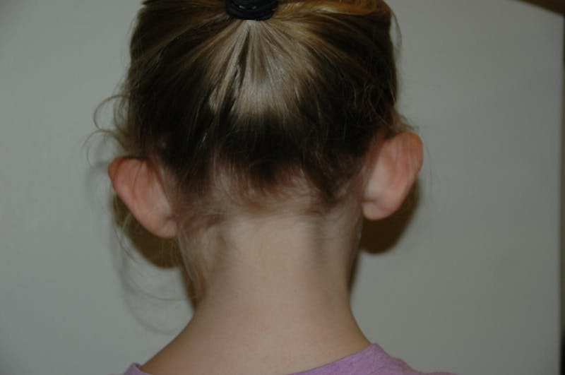 Otoplasty Before & After Gallery - Patient 53599915 - Image 3