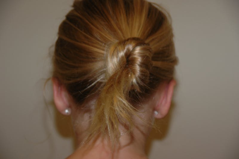Otoplasty Before & After Gallery - Patient 53599915 - Image 4