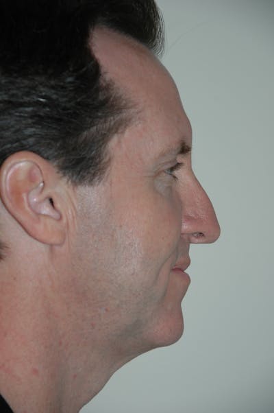 Revision Rhinoplasty Before & After Gallery - Patient 53599941 - Image 1