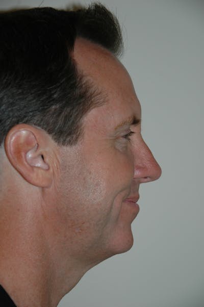 Revision Rhinoplasty Before & After Gallery - Patient 53599941 - Image 2