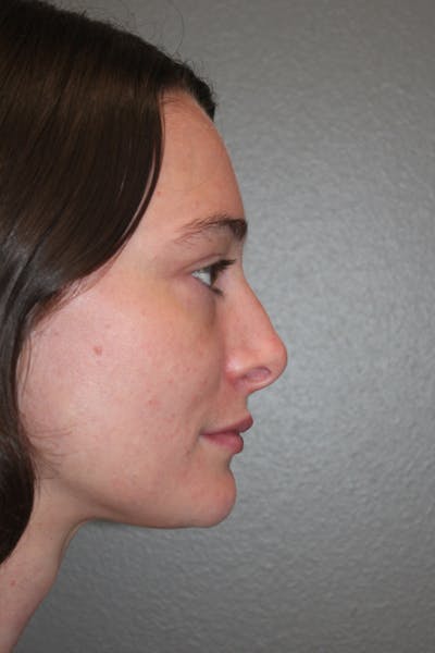 Revision Rhinoplasty Before & After Gallery - Patient 53599942 - Image 1