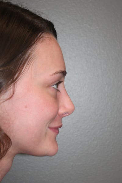 Revision Rhinoplasty Gallery - Patient 53599942 - Image 2