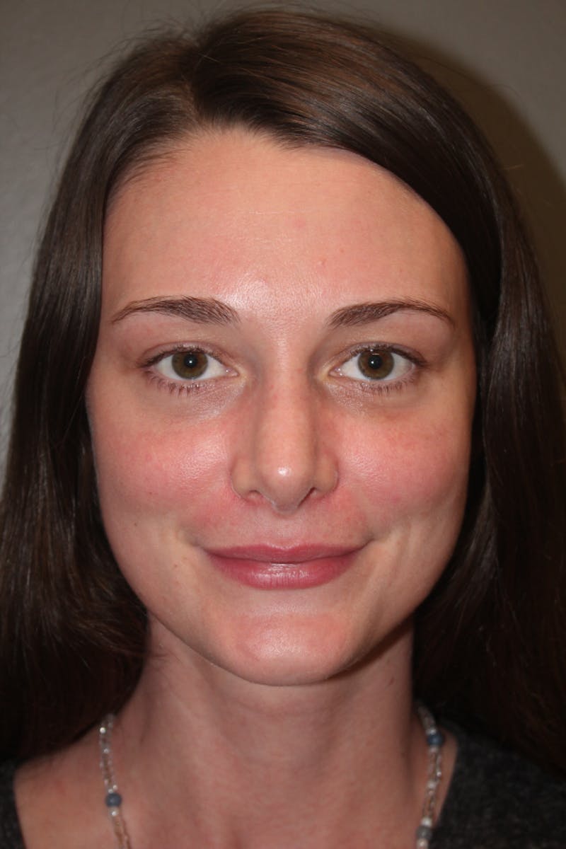 Revision Rhinoplasty Before & After Gallery - Patient 53599942 - Image 4