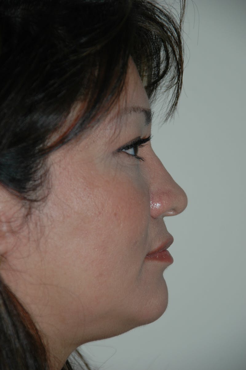Submental Liposuction Gallery - Patient 53599946 - Image 3