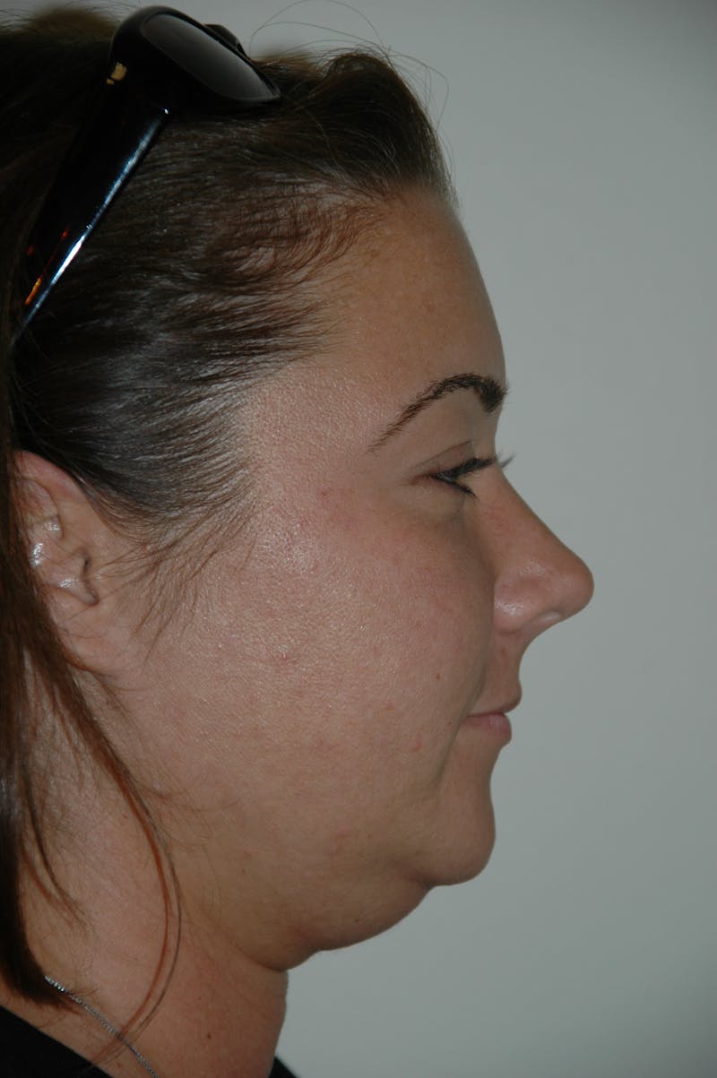Submental Liposuction Before & After Gallery - Patient 53599947 - Image 3