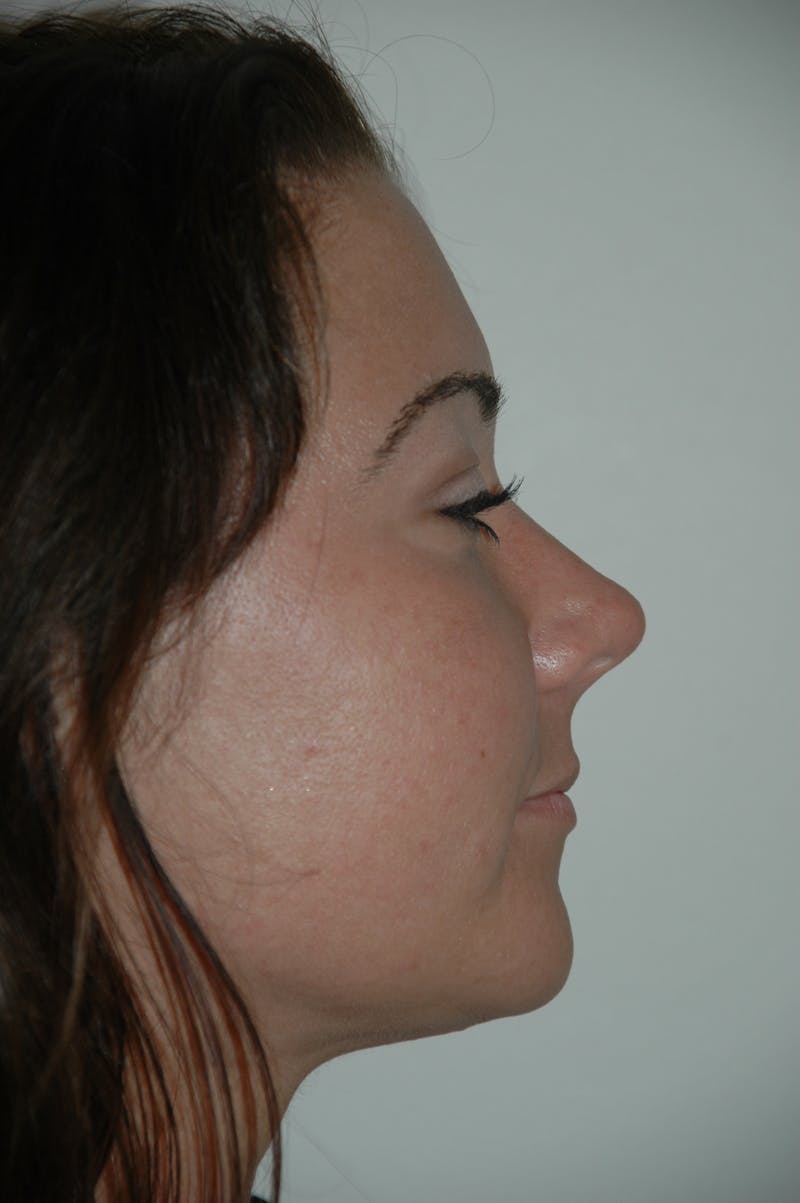 Submental Liposuction Gallery - Patient 53599947 - Image 4