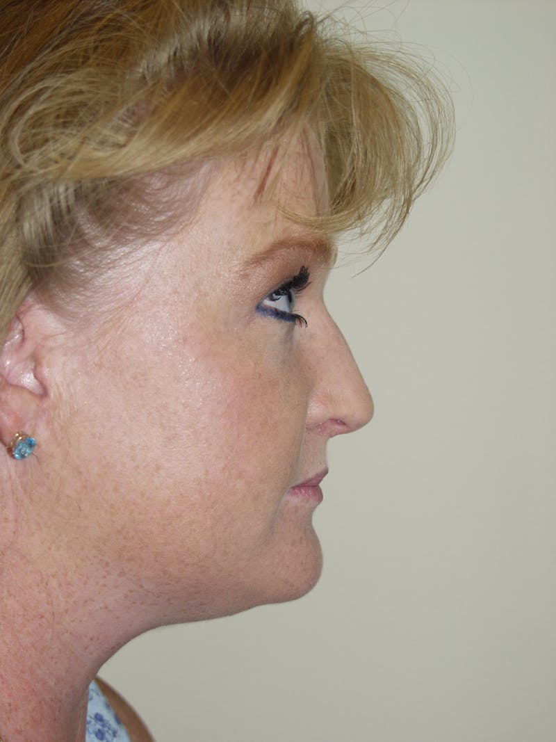 Submental Liposuction Before & After Gallery - Patient 53599948 - Image 3