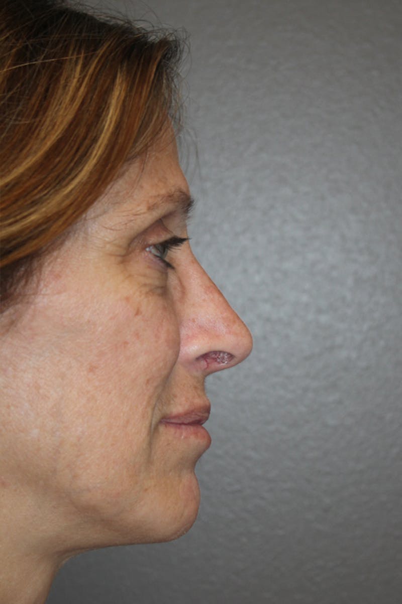 Rhinoplasty Before & After Gallery - Patient 53808855 - Image 2