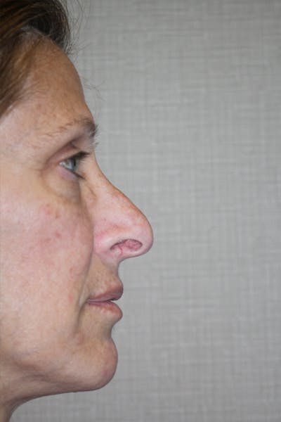 Rhinoplasty Before & After Gallery - Patient 53808855 - Image 1