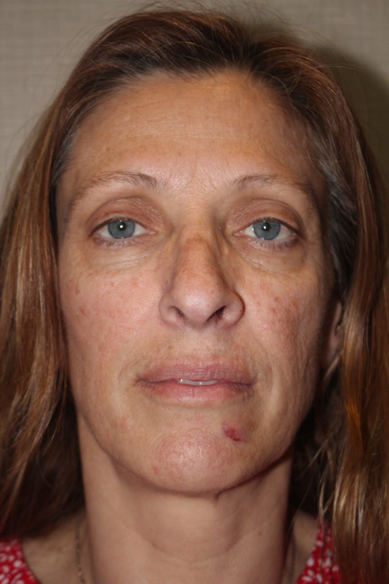 Rhinoplasty Before & After Gallery - Patient 53808855 - Image 3