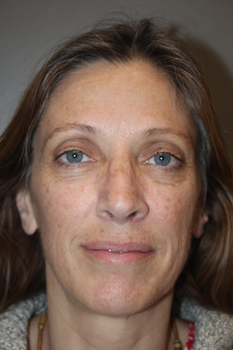 Rhinoplasty Before & After Gallery - Patient 53808855 - Image 4