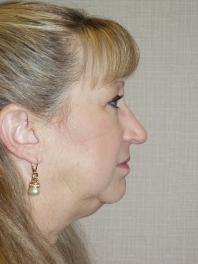 Rhinoplasty Before & After Gallery - Patient 53808879 - Image 1