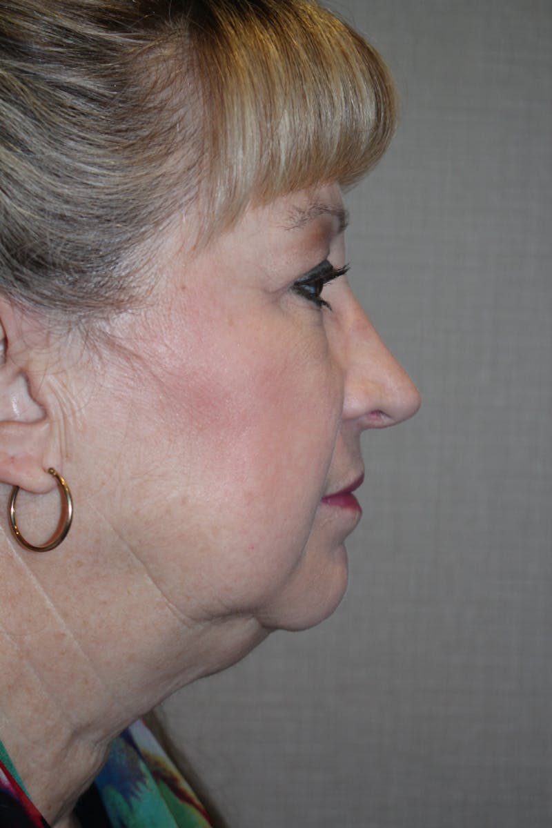 Rhinoplasty Before & After Gallery - Patient 53808879 - Image 2