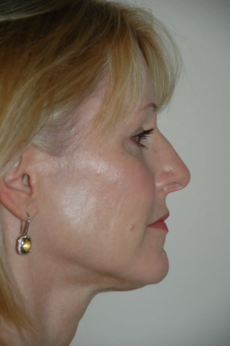 Rhinoplasty Before & After Gallery - Patient 53808922 - Image 1