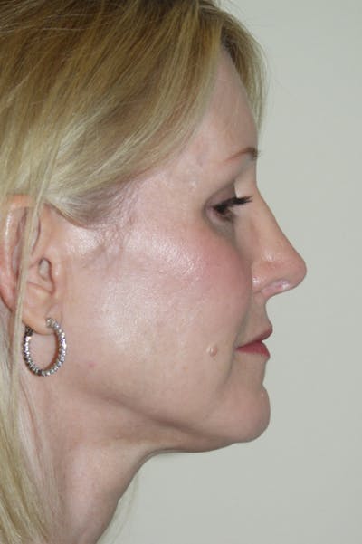 Rhinoplasty Before & After Gallery - Patient 53808922 - Image 2
