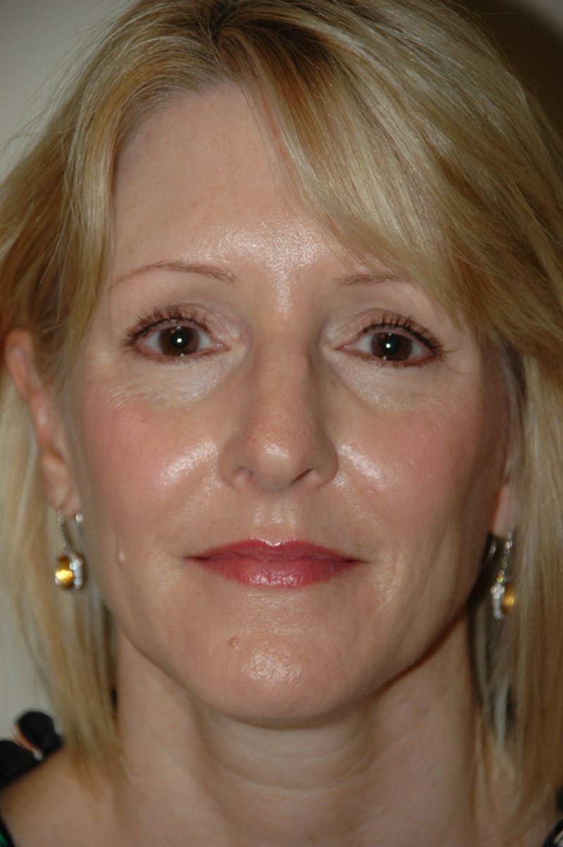 Rhinoplasty Before & After Gallery - Patient 53808922 - Image 3