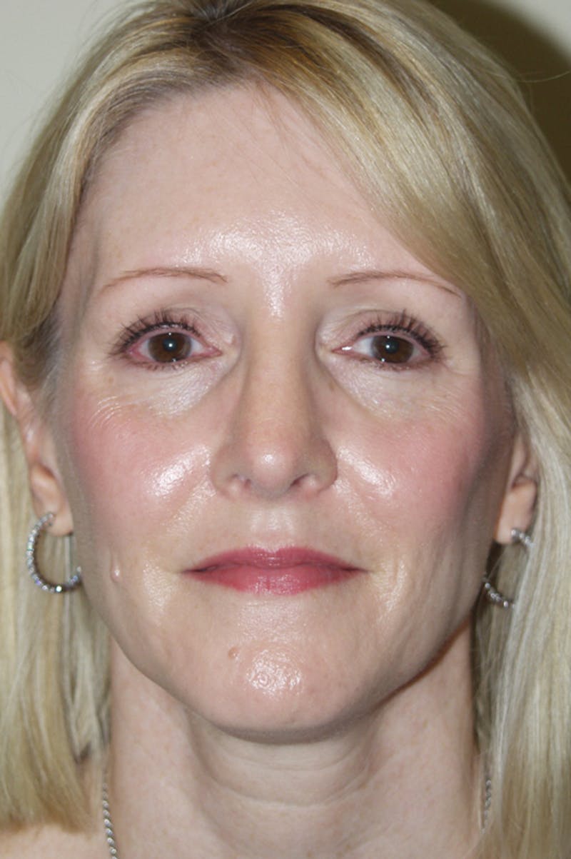 Rhinoplasty Before & After Gallery - Patient 53808922 - Image 4