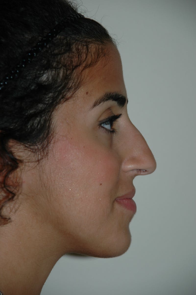 Rhinoplasty Before & After Gallery - Patient 53811571 - Image 1