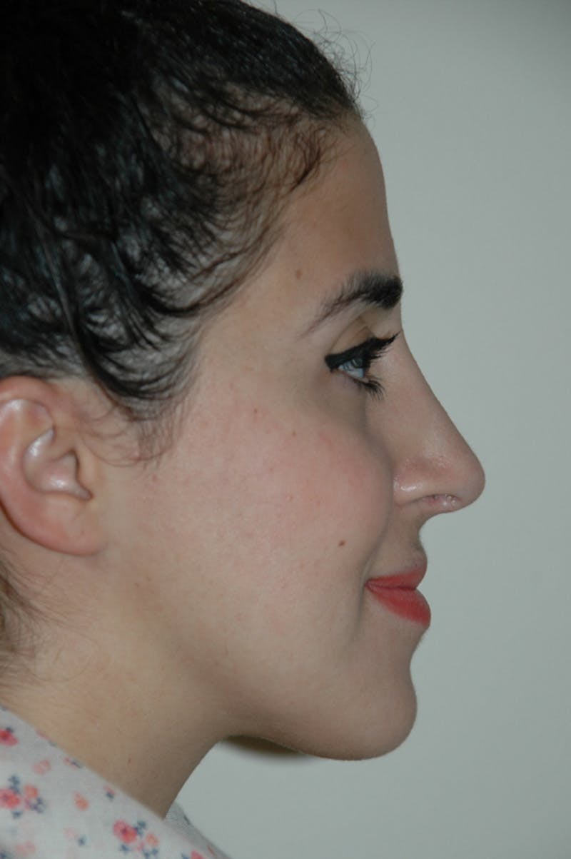 Rhinoplasty Before & After Gallery - Patient 53811571 - Image 2