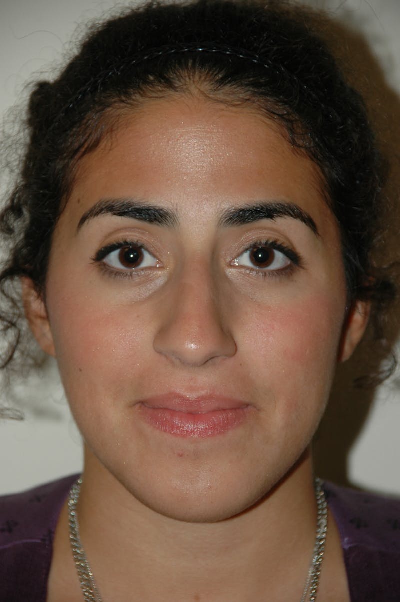 Rhinoplasty Before & After Gallery - Patient 53811571 - Image 3