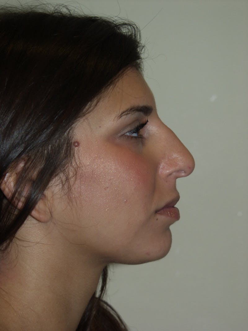 Rhinoplasty Before & After Gallery - Patient 53820292 - Image 1