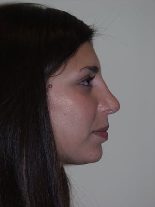 Rhinoplasty Before & After Gallery - Patient 53820292 - Image 2