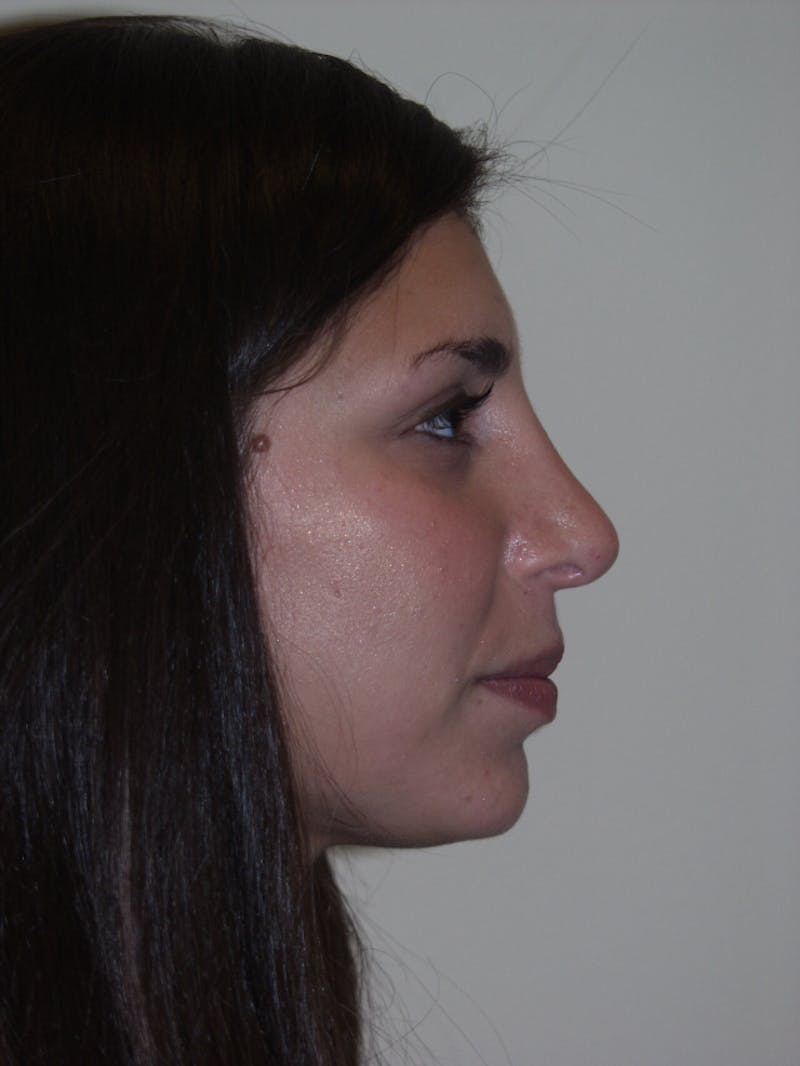 Rhinoplasty Before & After Gallery - Patient 53820292 - Image 2