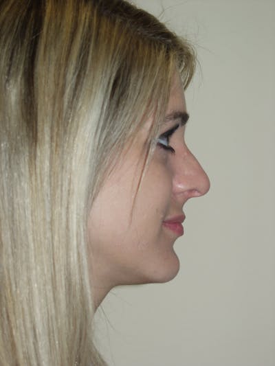 Rhinoplasty Before & After Gallery - Patient 53820352 - Image 1
