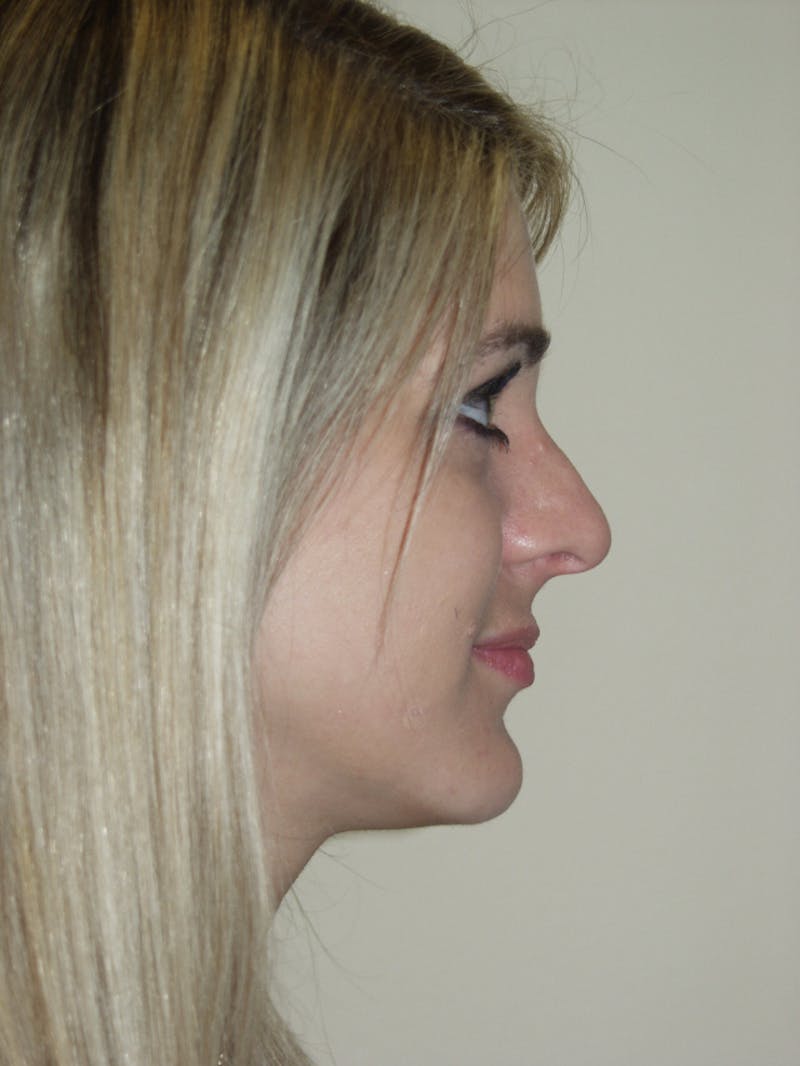 Rhinoplasty Before & After Gallery - Patient 53820352 - Image 1