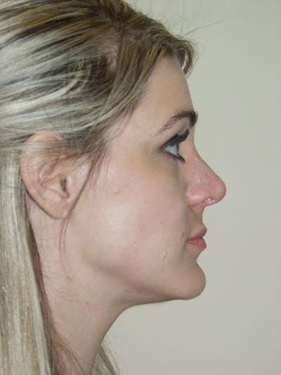Rhinoplasty Before & After Gallery - Patient 53820352 - Image 2