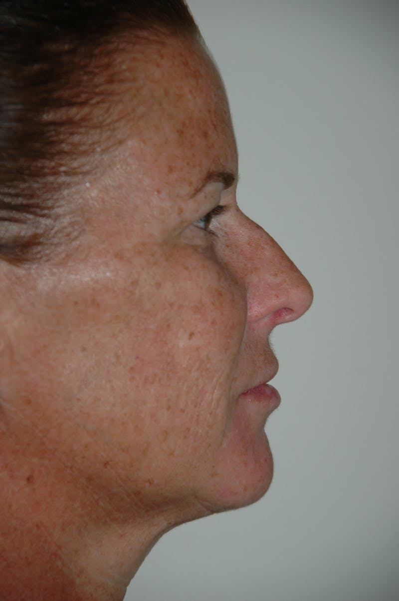 Rhinoplasty Before & After Gallery - Patient 53820353 - Image 1