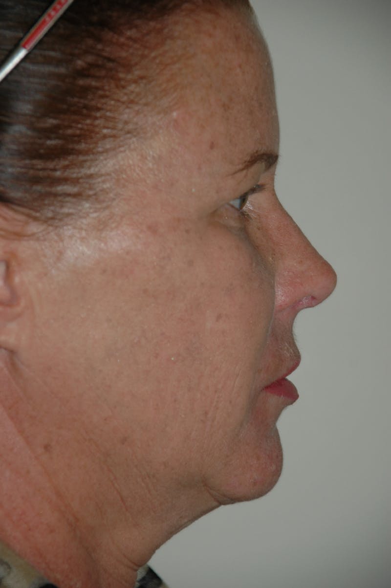 Rhinoplasty Before & After Gallery - Patient 53820353 - Image 2