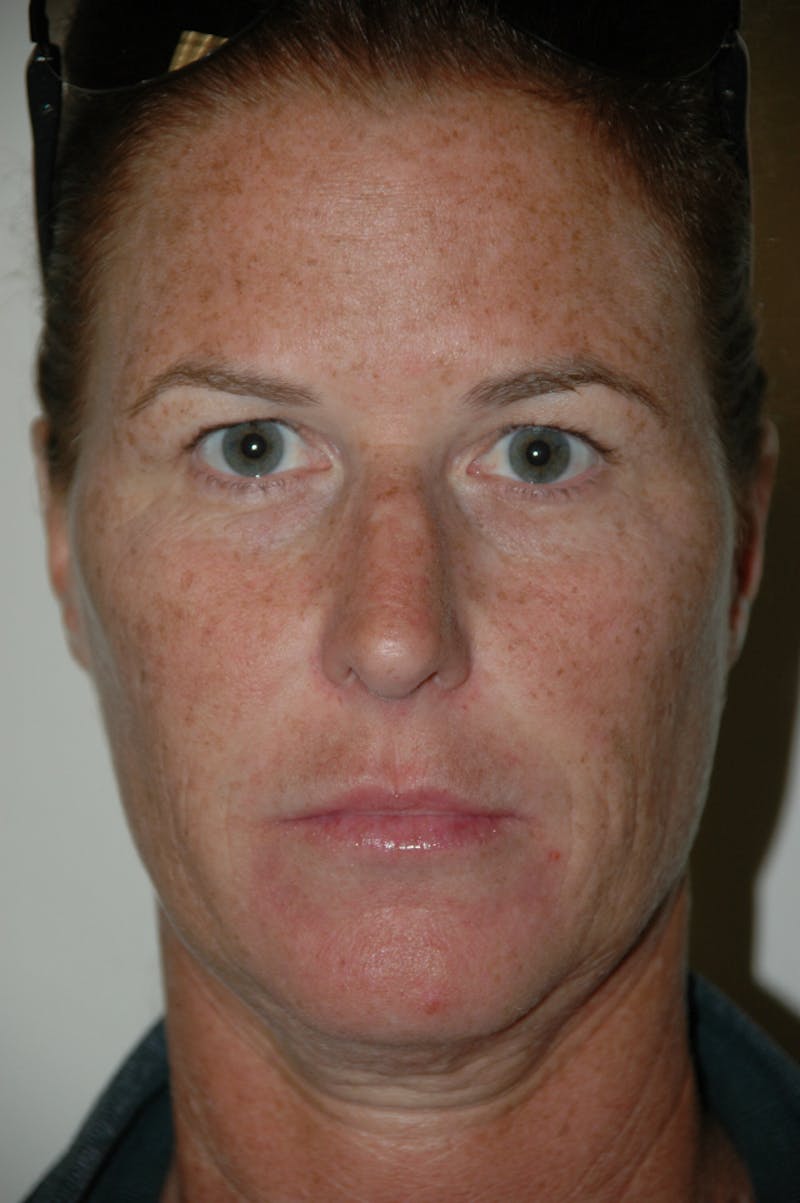 Rhinoplasty Before & After Gallery - Patient 53820353 - Image 3