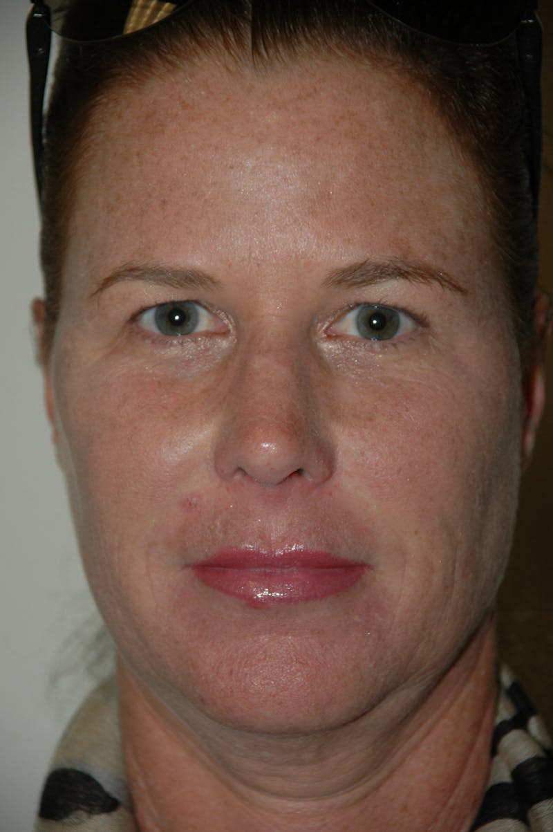 Rhinoplasty Before & After Gallery - Patient 53820353 - Image 4