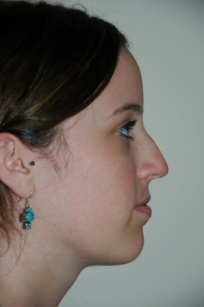 Rhinoplasty Before & After Gallery - Patient 53820369 - Image 1