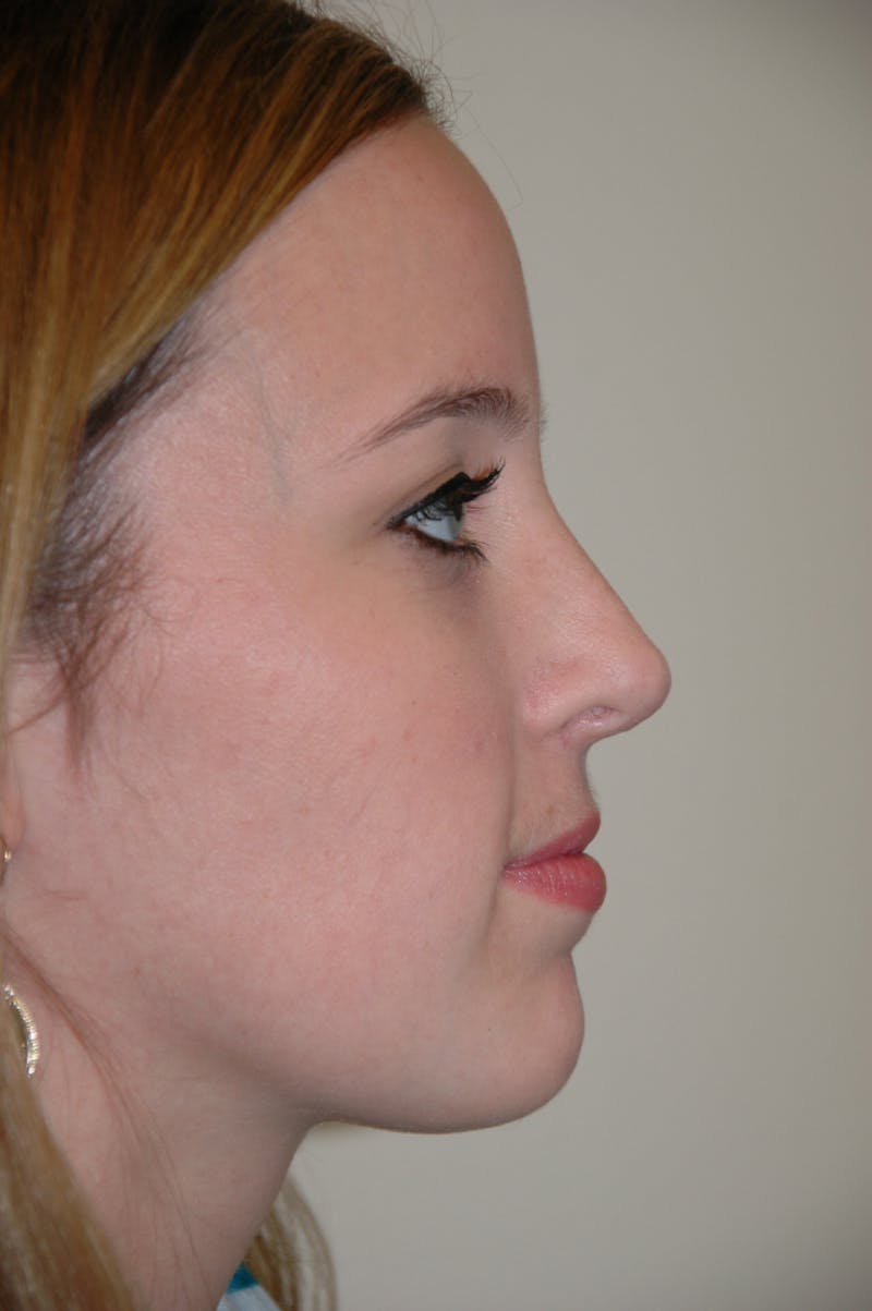 Rhinoplasty Before & After Gallery - Patient 53820369 - Image 2