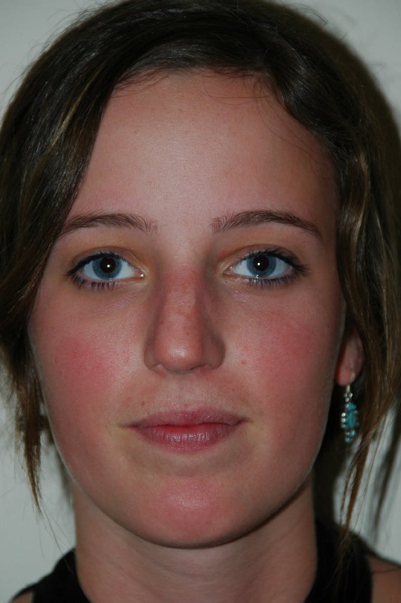 Rhinoplasty Before & After Gallery - Patient 53820369 - Image 3