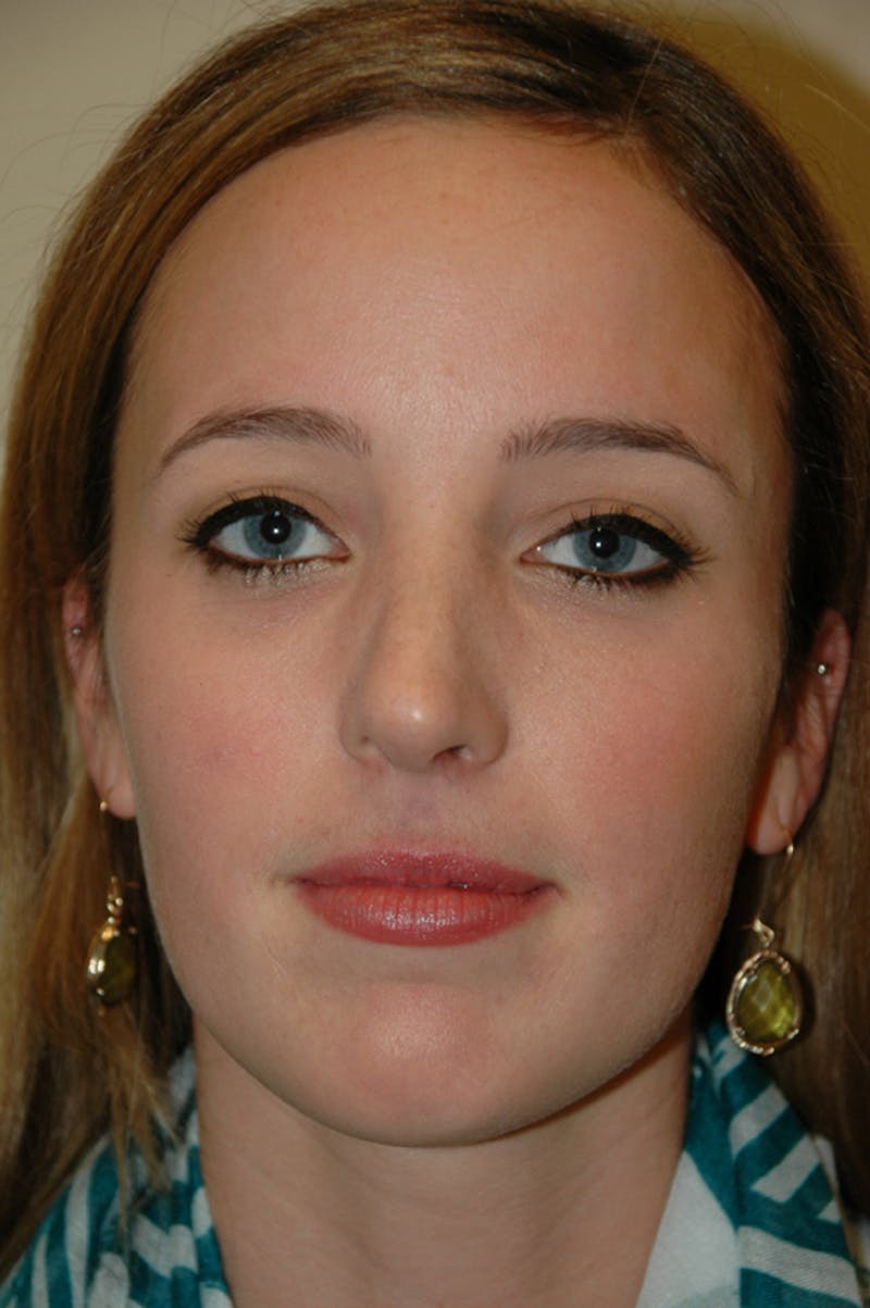Rhinoplasty Before & After Gallery - Patient 53820369 - Image 4