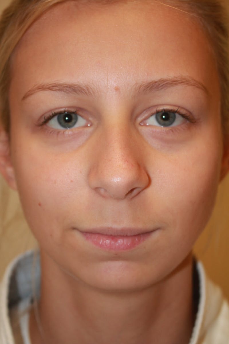 Rhinoplasty Before & After Gallery - Patient 53820388 - Image 3