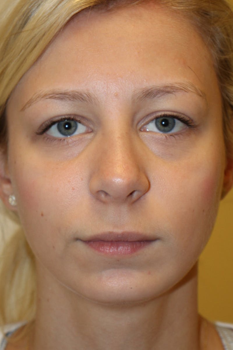 Rhinoplasty Before & After Gallery - Patient 53820388 - Image 4