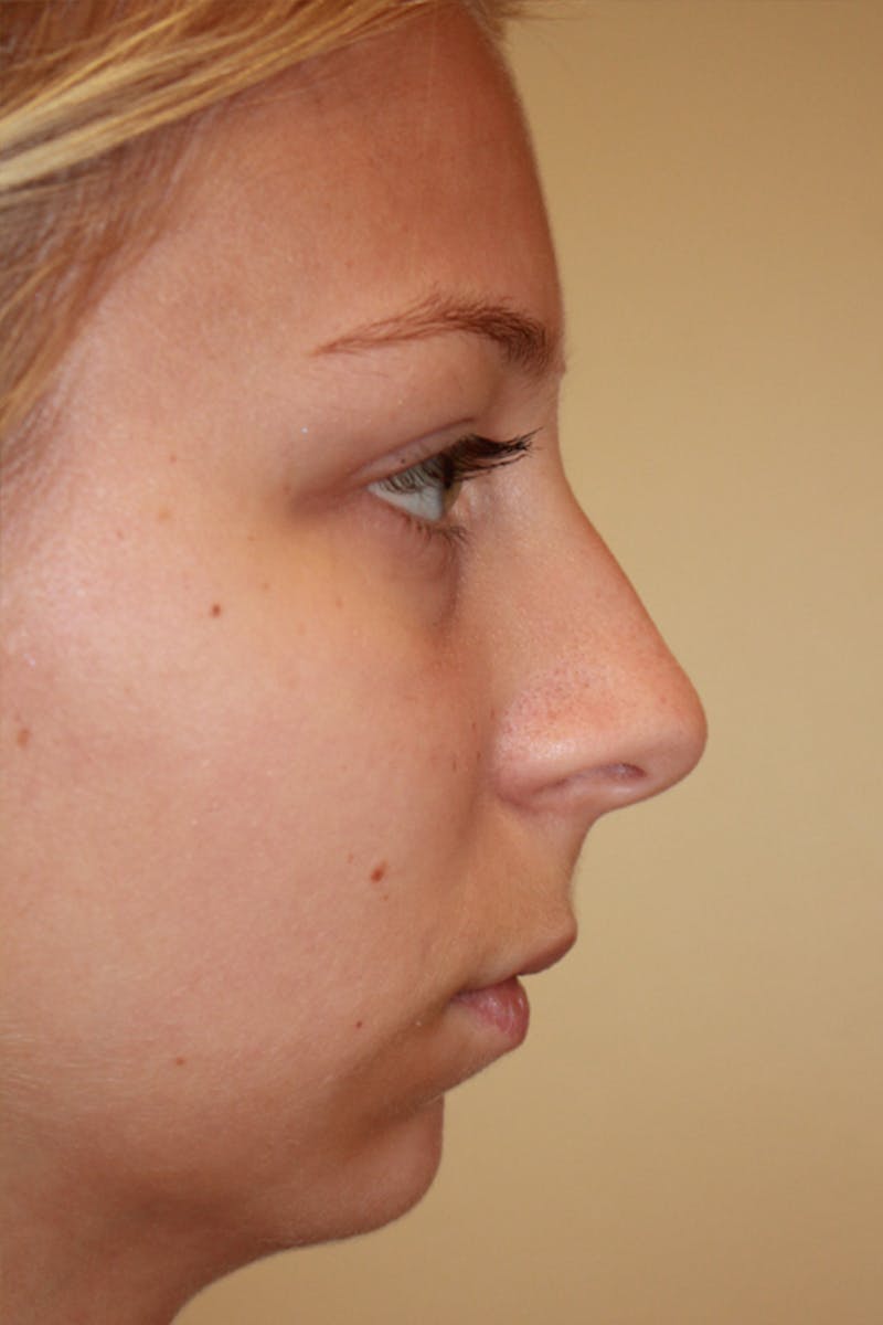 Rhinoplasty Before & After Gallery - Patient 53820388 - Image 1