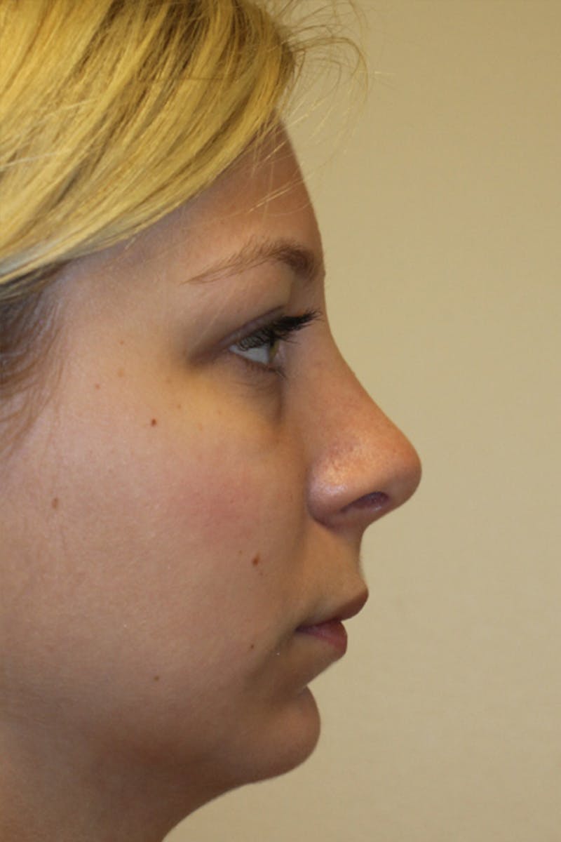 Rhinoplasty Before & After Gallery - Patient 53820388 - Image 2