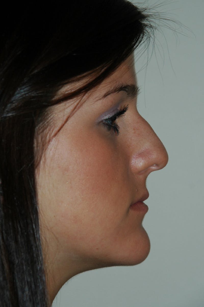 Rhinoplasty Before & After Gallery - Patient 53821199 - Image 1
