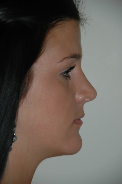 Rhinoplasty Before & After Gallery - Patient 53821199 - Image 2
