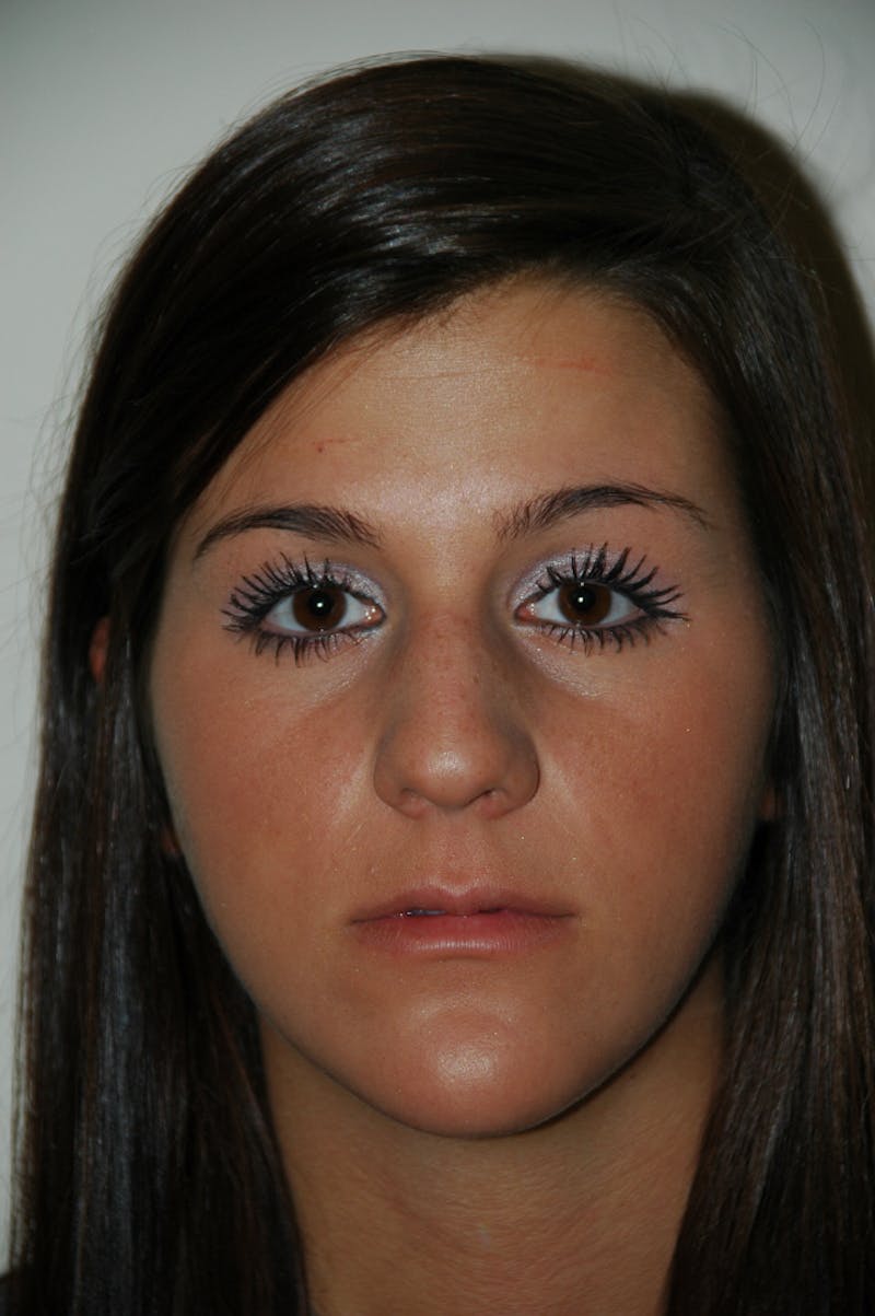 Rhinoplasty Before & After Gallery - Patient 53821199 - Image 3