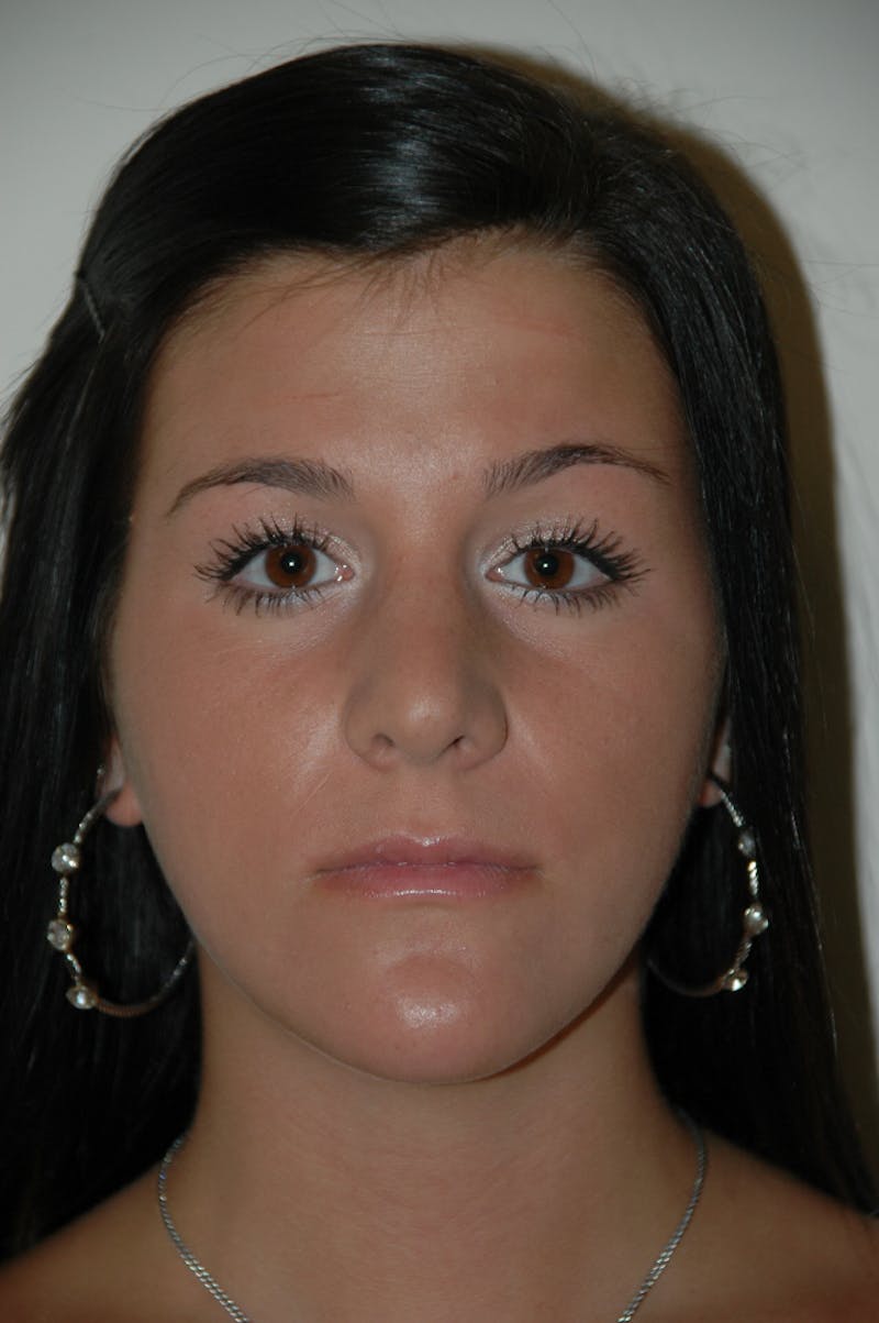 Rhinoplasty Before & After Gallery - Patient 53821199 - Image 4