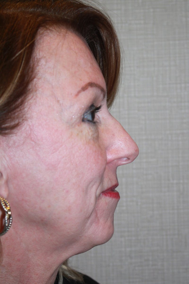 Rhinoplasty Before & After Gallery - Patient 53821256 - Image 1