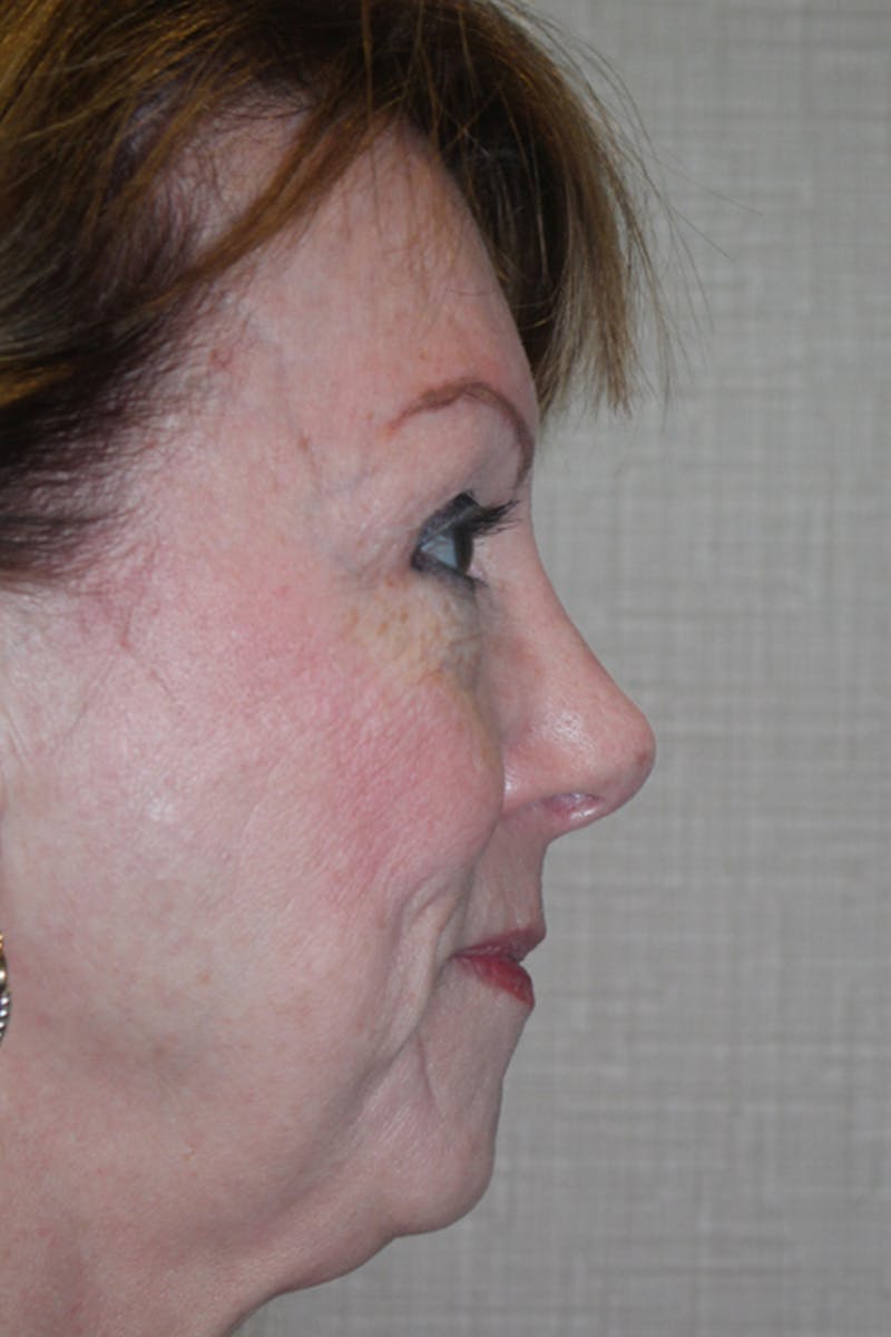 Rhinoplasty Before & After Gallery - Patient 53821256 - Image 2